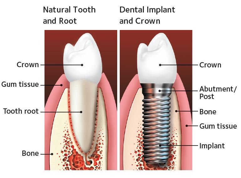 Missing Tooth Replacement 