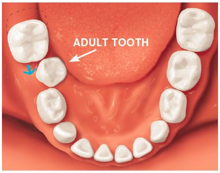 How Do You Know if Your Tooth is Rotten?