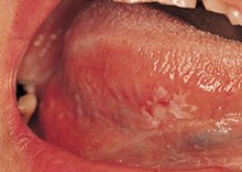 lingual tonsil cancer symptoms