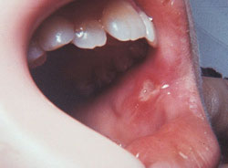 civilisation Udholdenhed Mechanics MOUTH SORES AND SPOTS | Specialized Dentistry