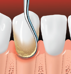 TREATING GUM DISEASE | Specialized Dentistry