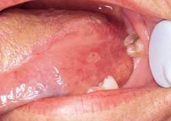 Mouth Sores And Spots Specialized