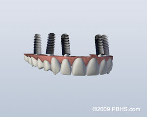 implant_retained_upper