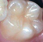 tooth-before-sealant