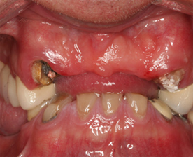 Tooth Replace Image