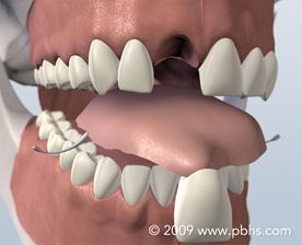 Tooth Replace Image