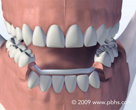Tooth Replace Image
