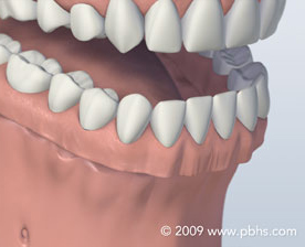 Tooth Replace Image