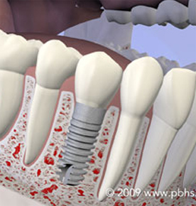 Tooth Replace Image