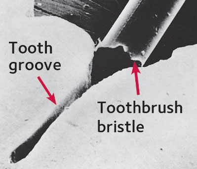 toothbrush-bristle-and-tooth-groove